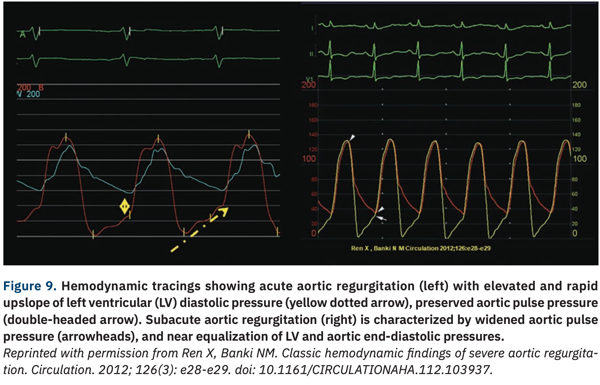 Hemodynamics That Can Make For a Lifesaving Decision in the Cath Lab